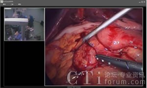 腹腔鏡手術(shù)截屏